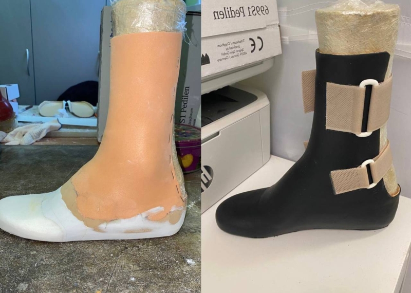 «Когда первый раз ходишь сам, ощущения классные»: как военнослужащие получают протезы в России