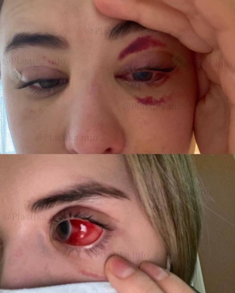 «Неделю терпела боли»: как пострадавшие от пластических операций россияне судятся за свои права