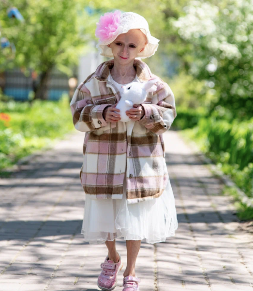 «У нас может и не быть завтра»: как в России живут дети с прогерией