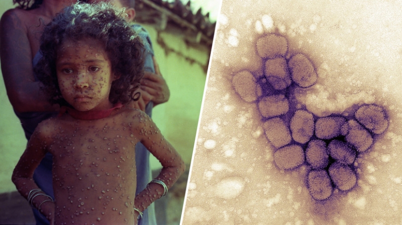 «Удалось вытеснить из природы»: как человечество победило натуральную оспу